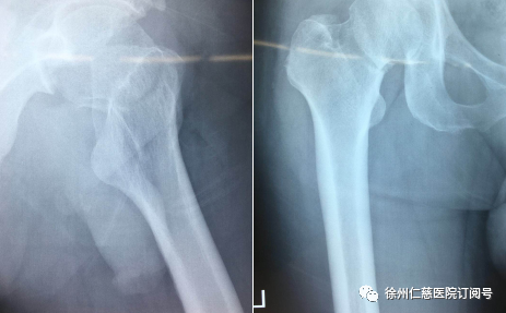 天璣骨科機(jī)器人
