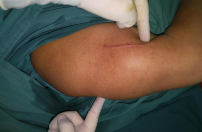 13cm的大腫瘤長在胳膊里十余年，徐州仁慈醫(yī)院手外科讓她重獲新生