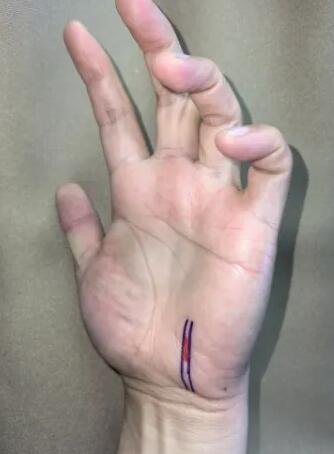 騎行60公里，她“累”到捏不起筷子 | 這是神經(jīng)損傷，可能需手術(shù)！